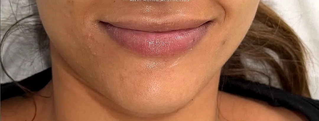 Signature Lips, before