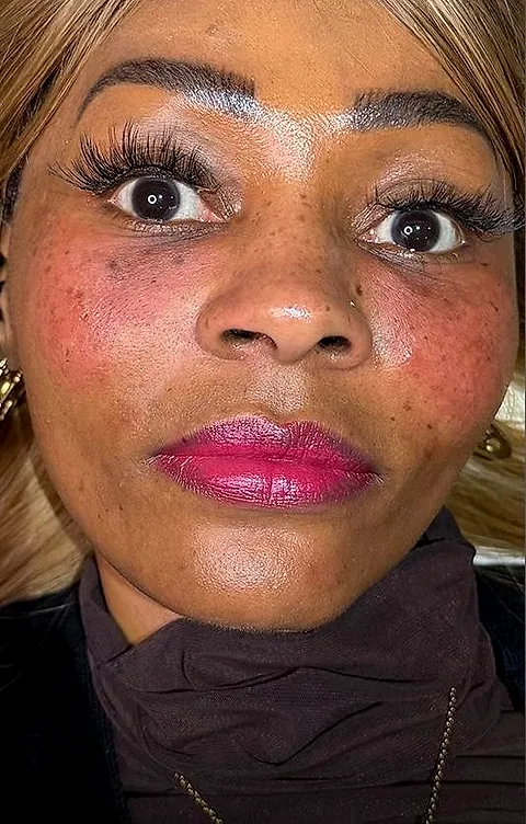 Tear trough filler, after