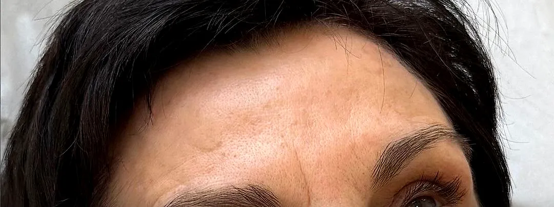 Anti-wrinkle, after