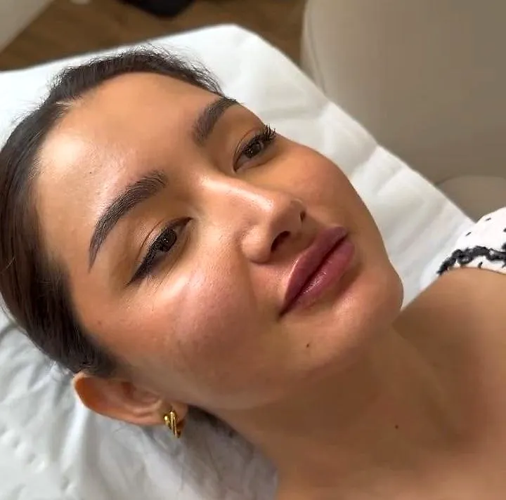 Patient after signature lip filler at Diez