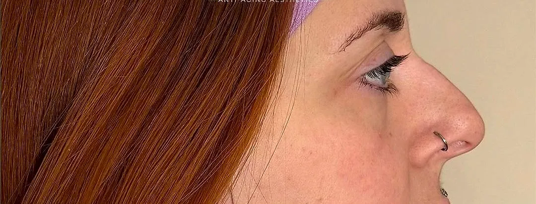 Liquid rhinoplasty, before