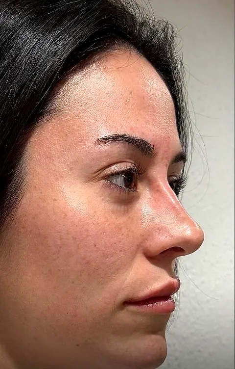 Side profile of a patient after facial harmonisation: liquid rhinoplasty and signature lips